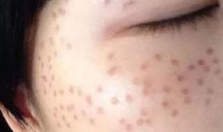 激光治疗雀斑的价格 激光治疗雀斑的价格